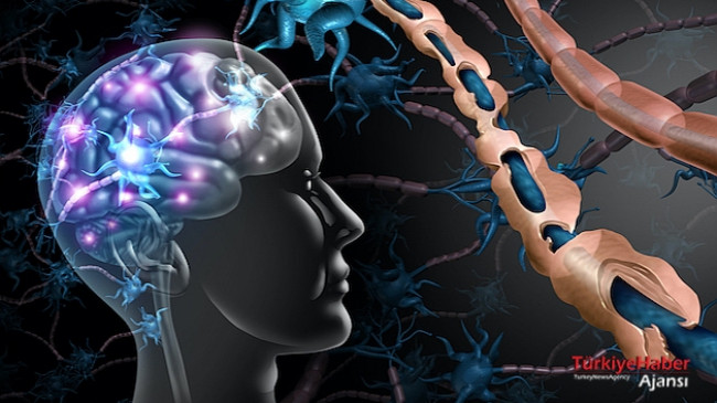 Multiple Skleroz (MS) Hastalığı Nedir Ve Tedavisi Nasıldır?  – Sağlık