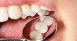 Diş dolgusu tedavisinin tüm bilinmeyenlerini Prof. Dr. Birkan Taha Özkan anlattı