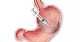 Mide botoksu için hastaneye inceleme