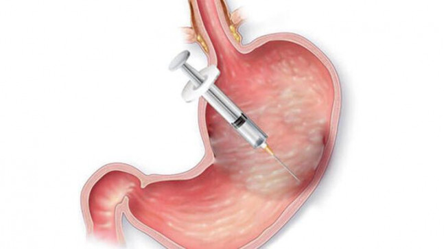 Mide botoksu için hastaneye inceleme
